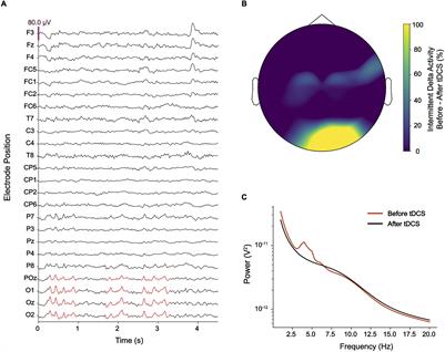 Pathological Delta Oscillations in Hallucinogen Persisting Perception Disorder: A Case Report